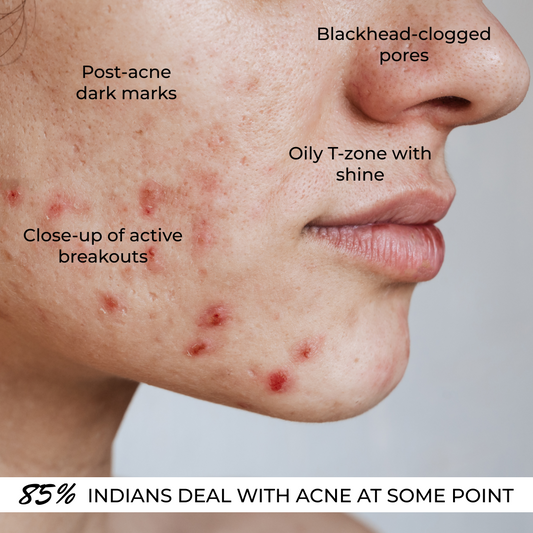 L’Offia ClearSkin 2% Salicylic Acid Acne Control Serum for Pimples & Oily Skin – 30ml