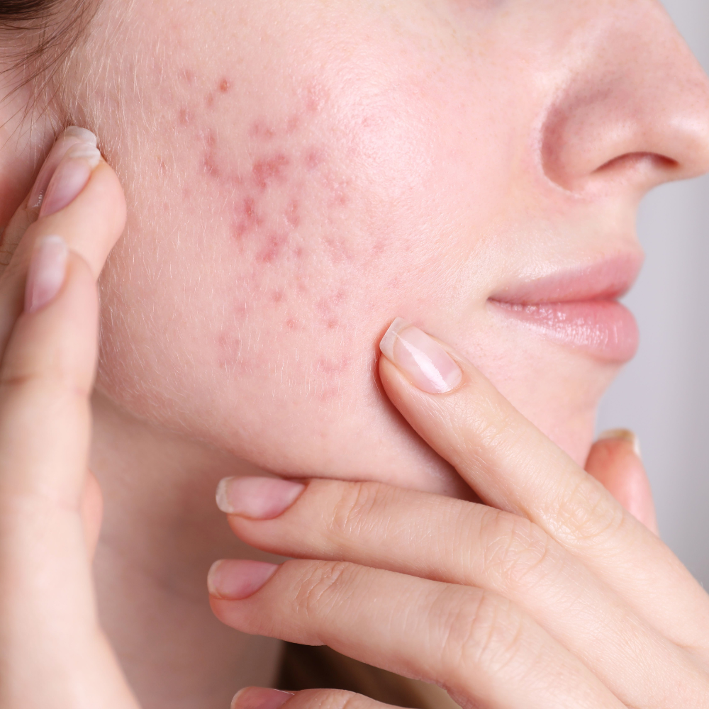 Acne/Pimple