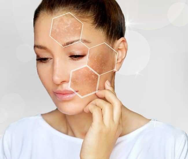 Pigmentation