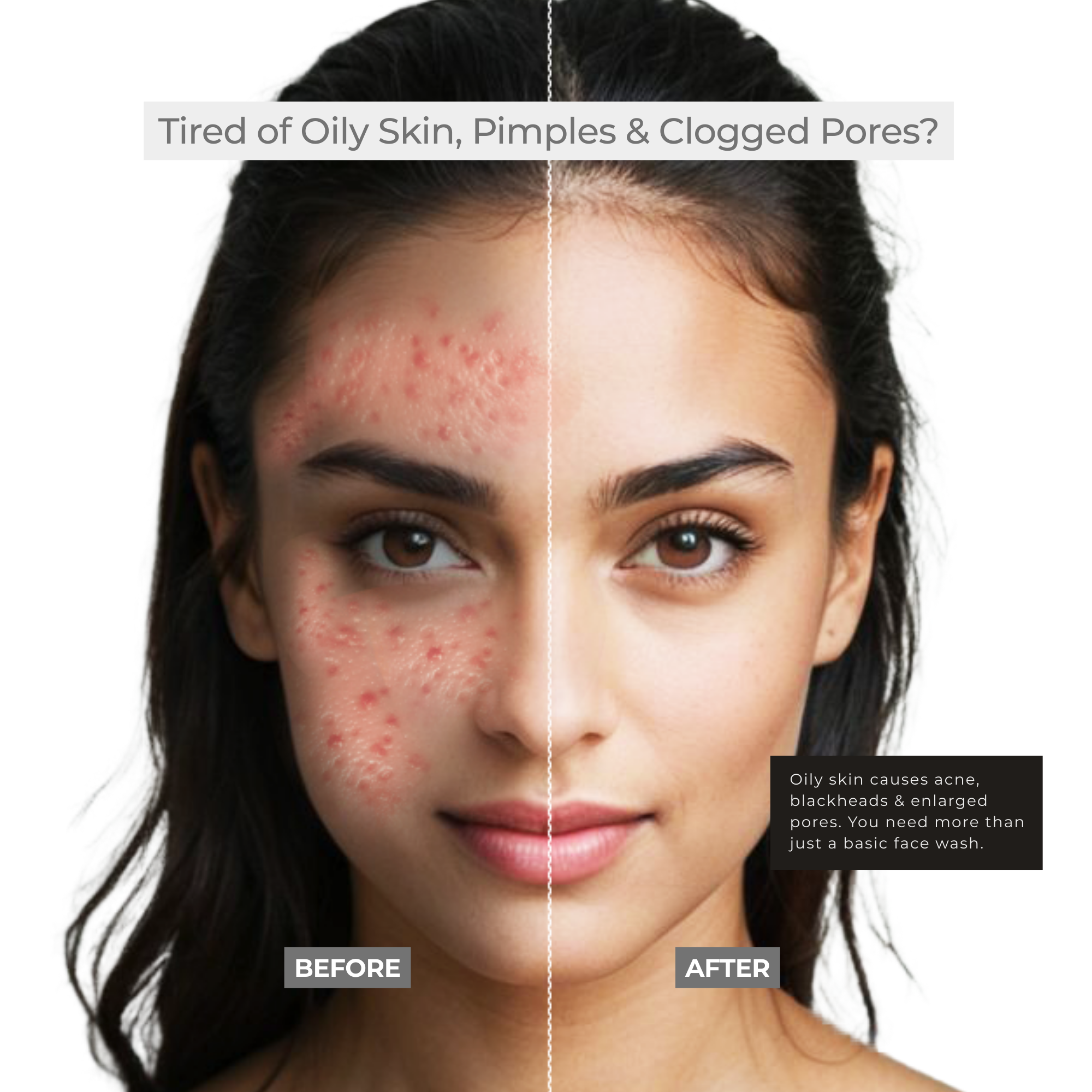 Niacinamide + Salicylic Acid Face Wash | Oil Control & Acne Care (100ml)